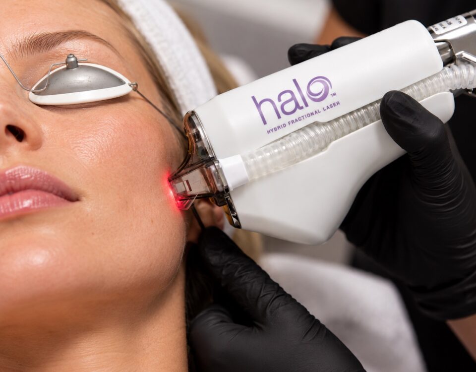 HALO Sciton hybridní frakční laser pro omlazení pleti